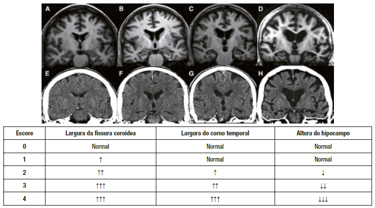 Referência visual Escala MTA — graus 0 a 4